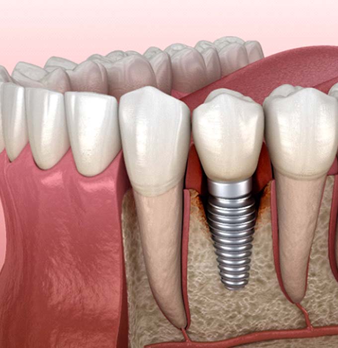 Illustration of failed dental implant in Flint, MI
