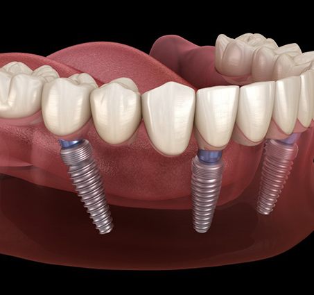 illustration of All on 4 dental implants in Flint