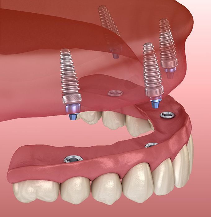 Illustration of a full implant denture being secured onto four dental implants