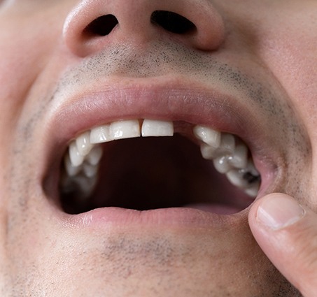 a man pointing to a missing tooth