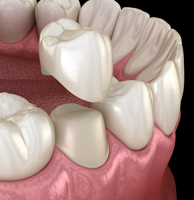 Animated dental crown restoration placement