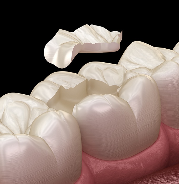 Animated tooth colored filling placement
