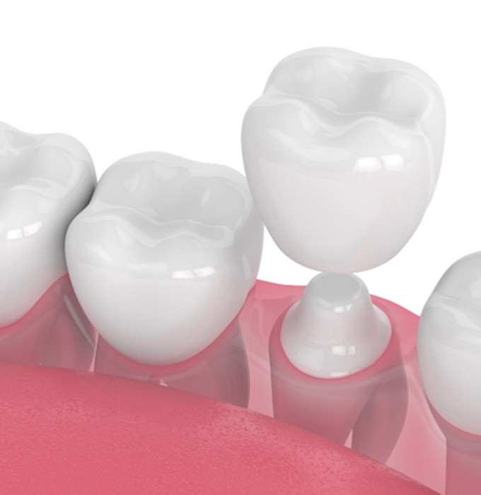 Illustration of CEREC same-day crown in Flint, MI being placed on tooth