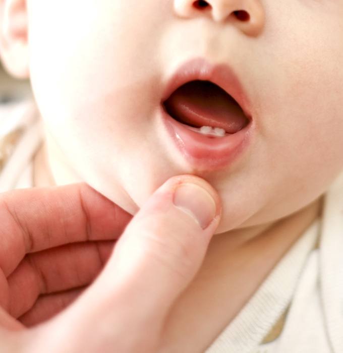 Dentist checking infant for frenectomy lip or tongue tie