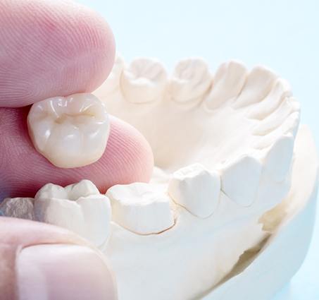 Placing a dental crown on a model of a tooth