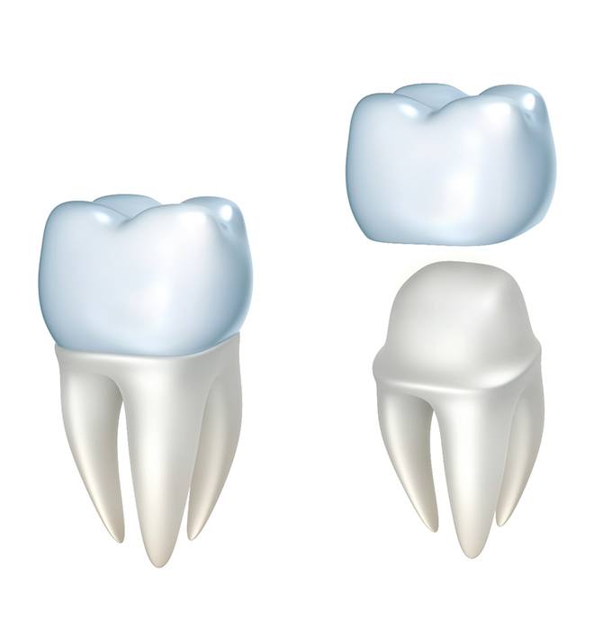 3D render of a dental crown