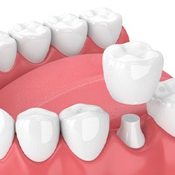 Illustration of a dental crown in Flint, MI being placed