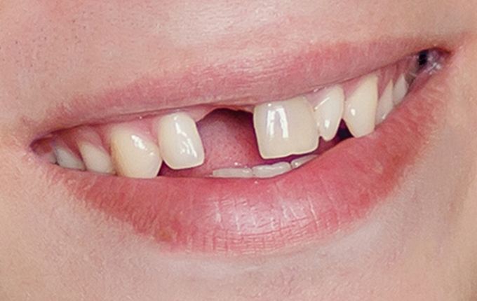 Closeup of smile with knocked out tooth