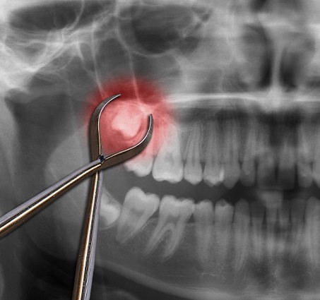 X-ray of smile with impacted wisdom tooth before extraction