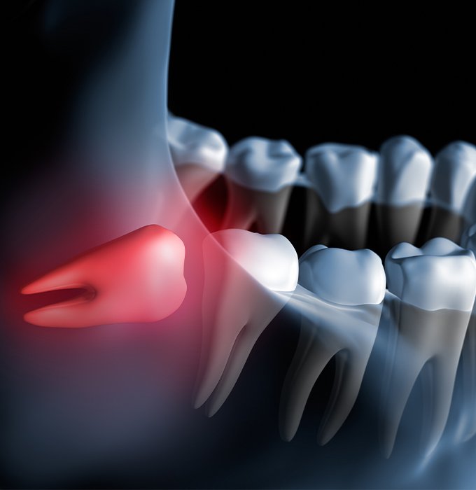 Animated smile with impacted wisdom tooth