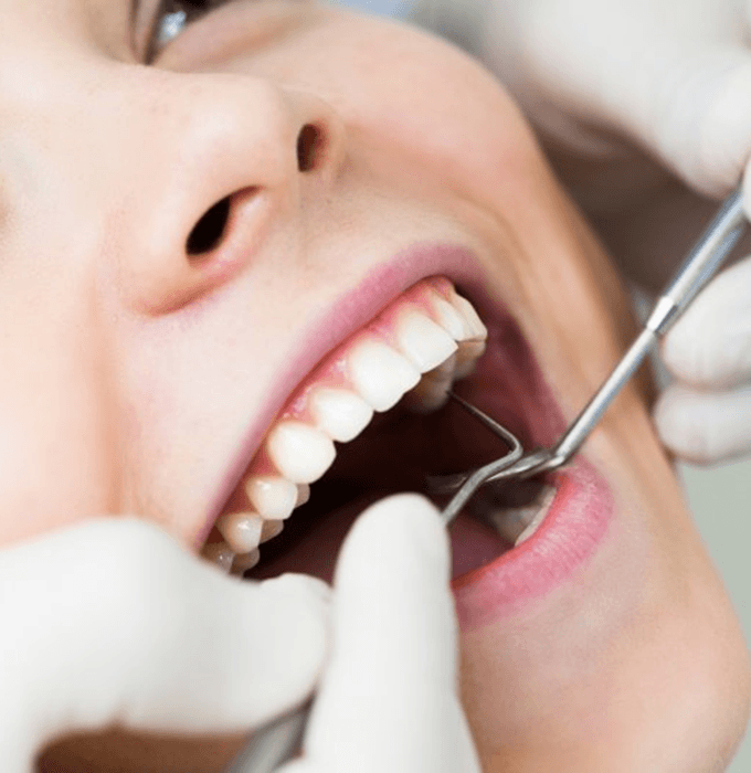 a patient in Flint undergoing the tooth-colored fillings process