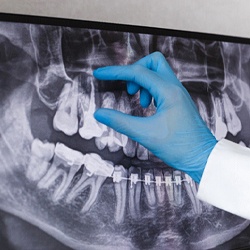 Dentist examining dental X-ray for dental implants in Flint