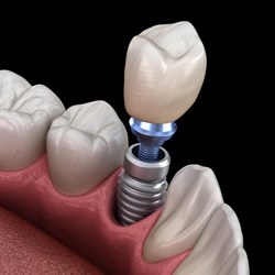 Diagram showing components of a dental implant in Flint