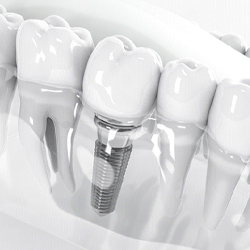 Diagram showing dental implant restored with dental crown