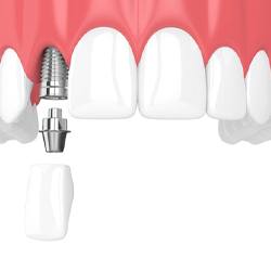 single dental implant with crown in upper arch