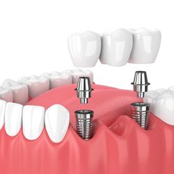 dental bridge over two dental implants