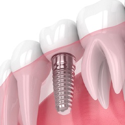 Model of dental implant in Flint, MI next to natural teeth