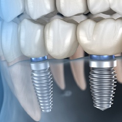 Two dental implants in Flint, MI supporting a dental bridge