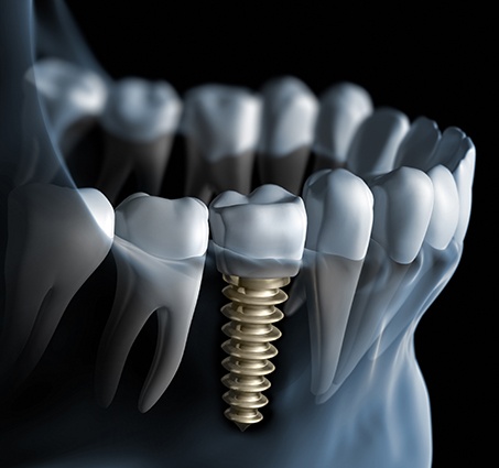 Animated smile with dental implant supported dental crown