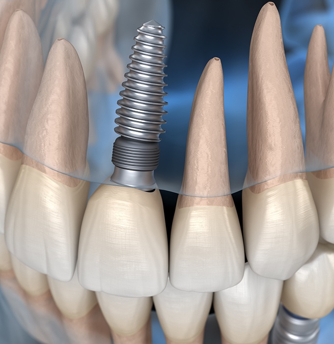 Animated smile with dental implant supported dental crown