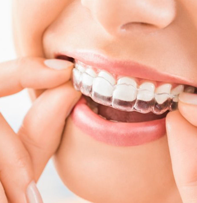 Person placing an Invisalign clear aligner in Flint over their teeth