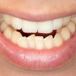 Close up of a smile with crowded lower teeth