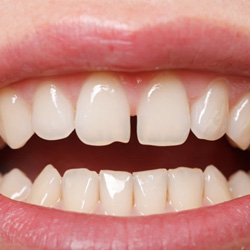 Close up of a smile with a small gap between the two front teeth