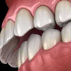 Illustration of a mouth with an overbite