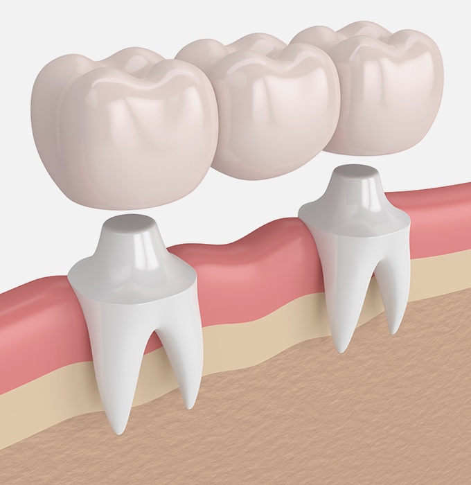 Animated dental bridge placement