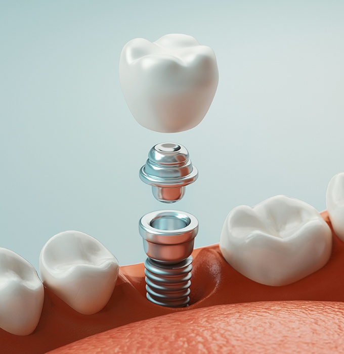 Animated dental implant supported dental crown placement