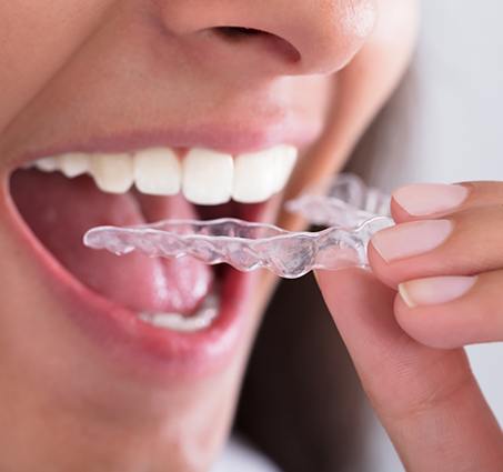 Patient placing clear orthodontic aligner tray