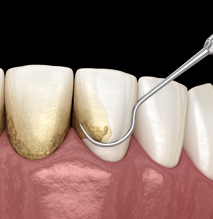 Patient receiving scaling and root planing treatment