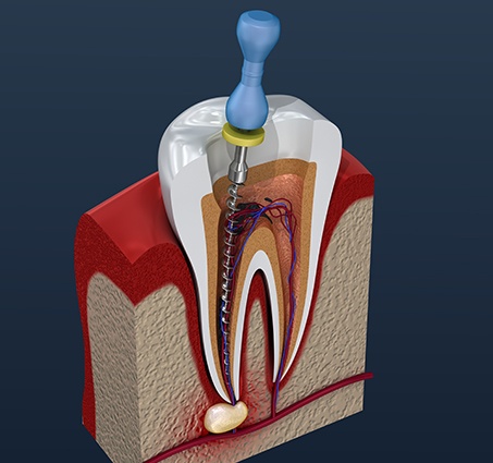 Animated root canal therapy process