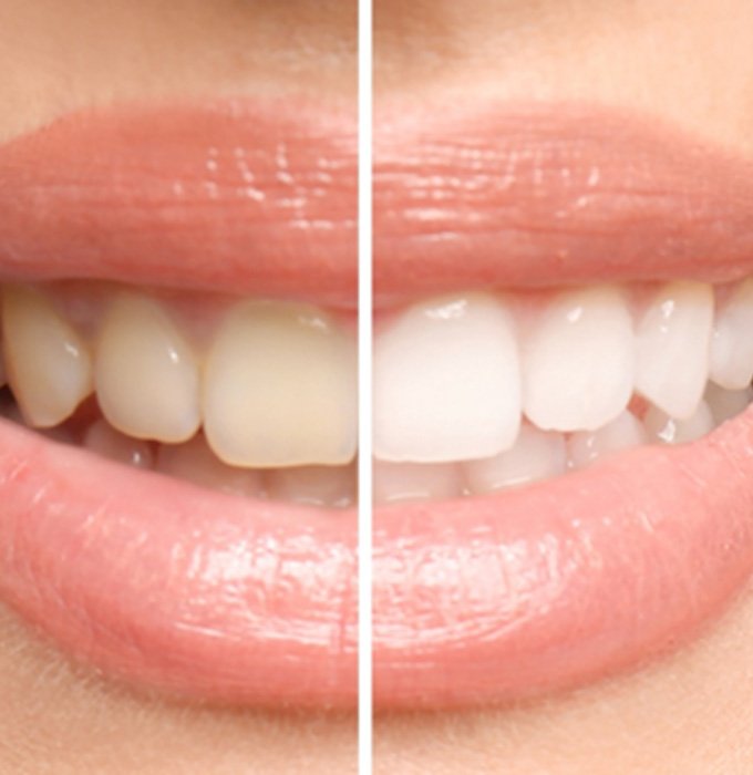 Before and after teeth whitening